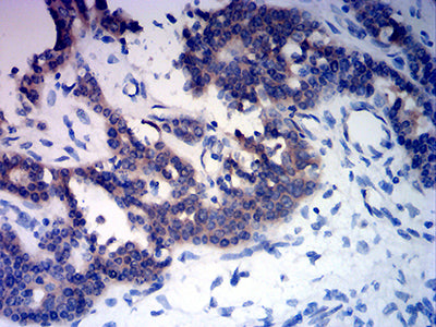 Immunohistochemistry: RABEP2 Antibody (2B1B6) [NBP3-27176] - Analysis of paraffin-embedded ovarian cancer tissues using RABEP2 mouse mAb with DAB staining.