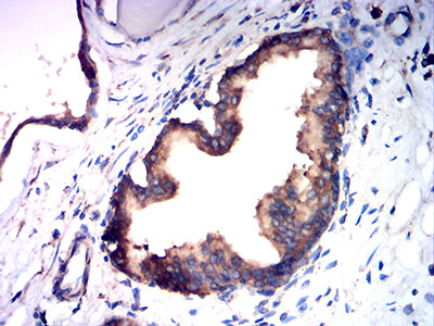 Immunohistochemistry: TSPAN16 Antibody (5A2C10) [NBP3-27178] - Analysis of paraffin-embedded prostate cancer tissues using TSPAN16 mouse mAb with DAB staining.