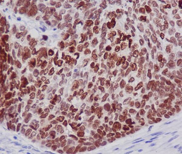 Immunohistochemistry-Paraffin: HIST1H2BK Antibody (SR3153) [NBP3-27749] - Immunohistochemical analysis of paraffin-embedded human lung cancer