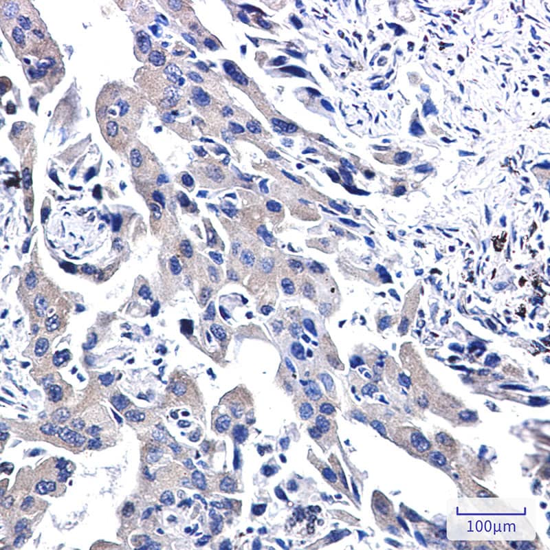 Immunohistochemistry-Paraffin: WWOX Antibody (SR2547) [NBP3-27813] - Immunohistochemistry analysis of paraffin-embedded Human lung cancer. High-pressure and temperature Sodium Citrate pH 6.0 was used for antigen retrieval.