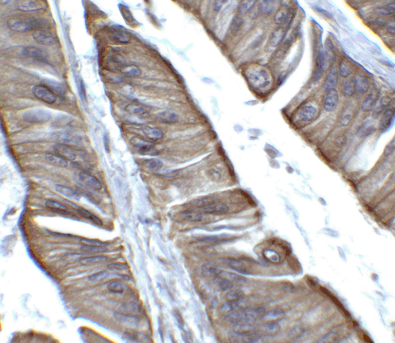 Immunohistochemistry: TET2 Antibody [NBP3-27879] - Immunohistochemistry of TET2 in human colon carcinoma tissue with TET2 antibody at 2 u/ml.