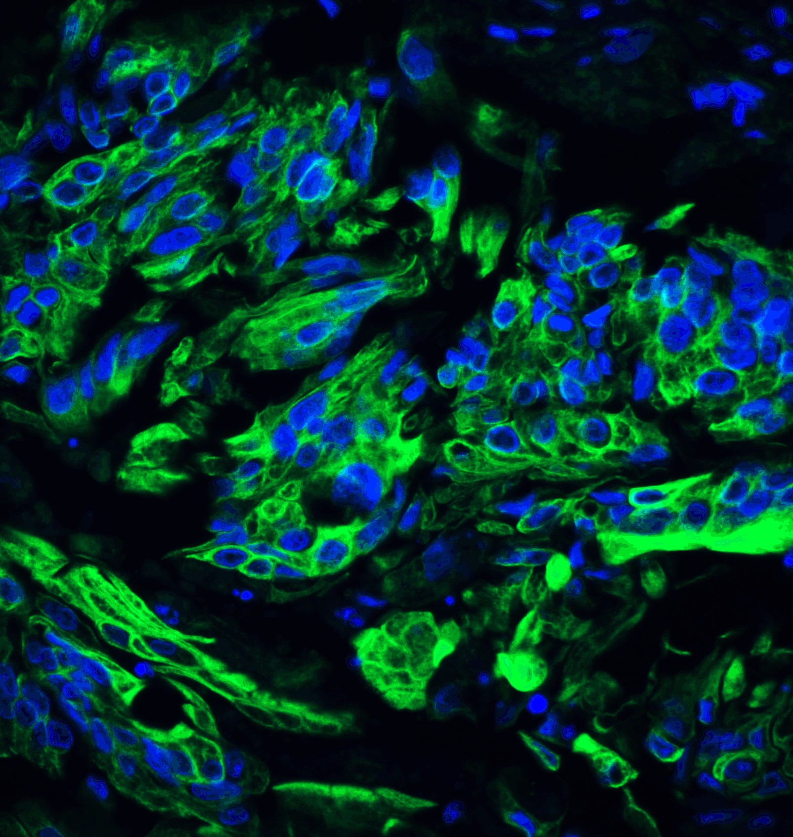 Immunocytochemistry/ Immunofluorescence: TET2 Antibody [NBP3-27879] - Immunofluorescence of TET2 in human colon carcinoma tissue with TET2 antibody at 20 u/ml.Green: TET2 Antibody   Blue: DAPI staining