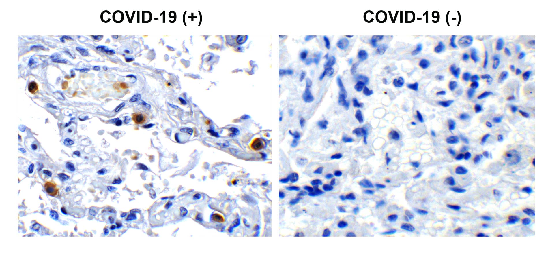 Immunohistochemistry: SARS-CoV-2 pp1ab polyprotein Antibody [NBP3-27904] - Immunohistochemical analysis of paraffin-embedded COVID-19 patient lung tissue using anti- SARS-CoV-2 (COVID-19) NSP16 antibody (0.5 u/mL). Tissue was fixed with formaldehyde and blocked with 10% serum for 1 h at RT; antigen retrieval was by heat mediation with a citrate buffer (pH6). Samples were incubated with primary antibody overnight at 4C. A goat anti-rabbit IgG H&L (HRP) at 1/250 was used as secondary. Counter stained with Hematoxylin. Strong signal of SARS-COV-2 NSP16 protein was observed in macrophage of COVID-19 patient lung, but not in non-COVID-19 patient lung.
