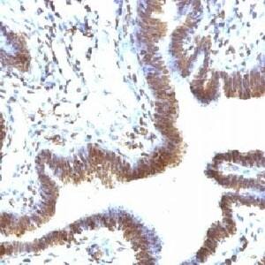 Immunohistochemistry: EMI1 Antibody (FBXP5) [NBP3-27923] - IHC testing of FFPE human ovarian carcinoma and EMI1 antibody (FBXP5).