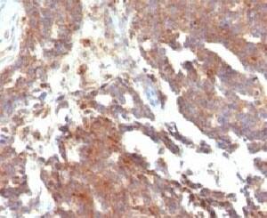 Immunohistochemistry: GnRHR Antibody (LCHR37) [NBP3-27924] - IHC testing of FFPE human ovarian carcinoma and GnRHR antibody (clone LCHR37)