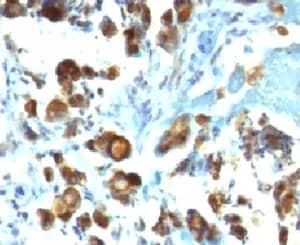 Immunohistochemistry: MUC3 Antibody (MUCN3-1) [NBP3-27926] - IHC testing of FFPE human gastric carcinoma with MUC3 antibody (clone MUCN3-1).