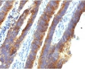 Immunohistochemistry: MUC3 Antibody (MUCN3-1) [NBP3-27926] - IHC testing of FFPE human colon carcinoma with MUC3 antibody (clone MUCN3-1).