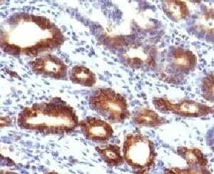 Immunohistochemistry: MUC6 Antibody (MUCN6-1) [NBP3-27927] - IHC testing of FFPE human gastric carcinoma with MUC6 antibody (clone MUCN6-1).