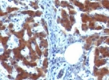 Immunohistochemistry: Retinol Binding Protein RBP Antibody (RLBD1) [NBP3-27928] - IHC testing of FFPE human hepatocellular carcinoma  with Retinol Binding Protein RBP (clone RLBD1)