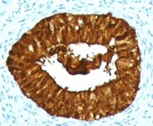 Immunohistochemistry: MAML3 Antibody (MMLP3-1) [NBP3-27931] - IHC testing of FFPE human cervical carcinoma with MAML3 antibody (clone MMLP3-1).