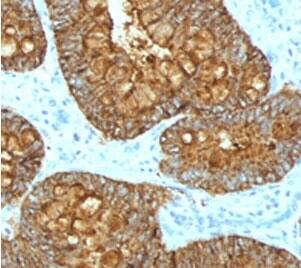 Immunohistochemistry: MAML3 Antibody (MMLP3-1) [NBP3-27931] - IHC testing of FFPE human colon carcinoma with MAML3 antibody (clone MMLP3-1).