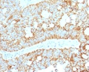 Immunohistochemistry: MAML2 Antibody (MMLP2-1) [NBP3-27933] - IHC testing of FFPE human colon carcinoma with MAML2 antibody (clone MMLP2-1).