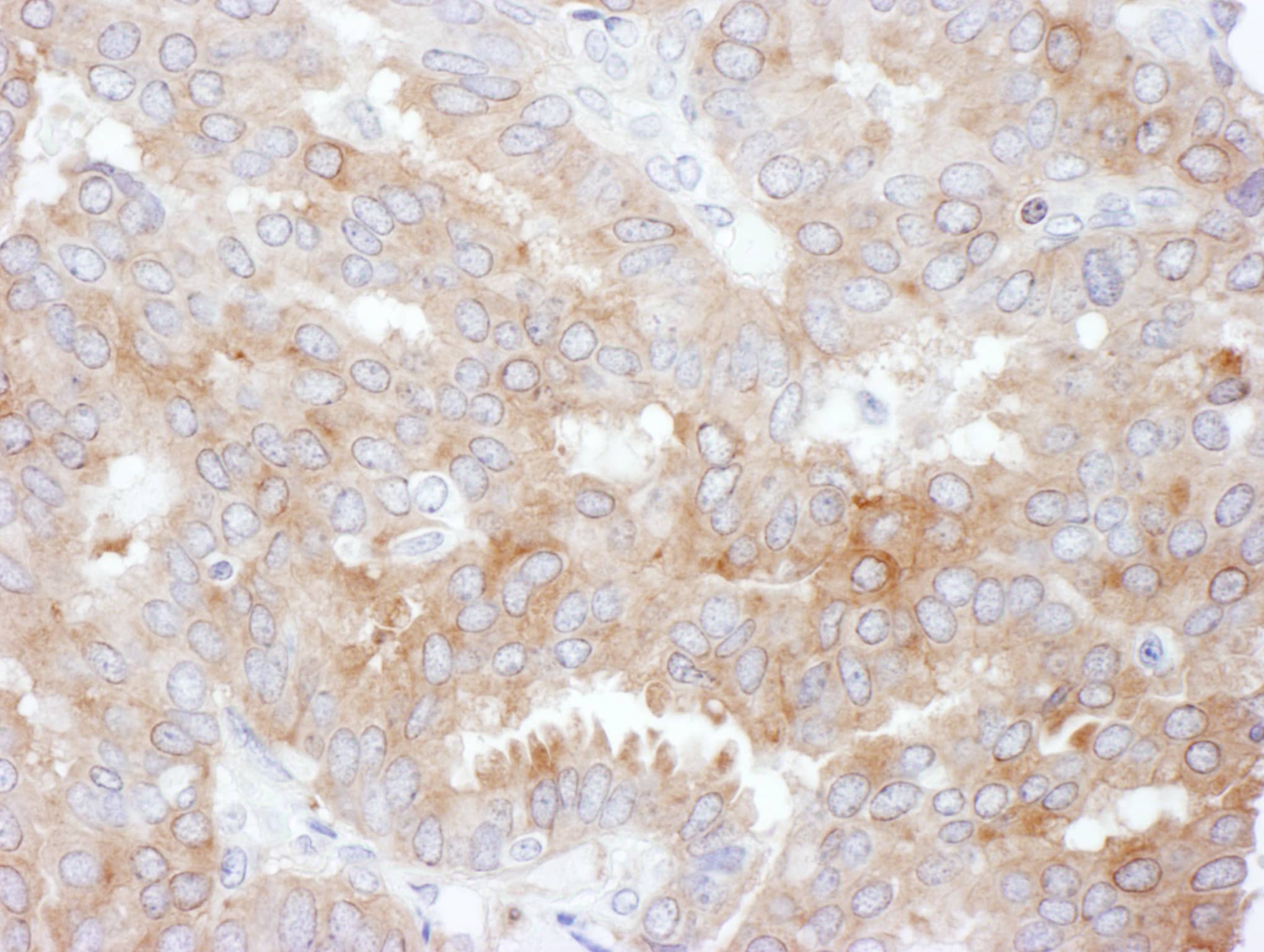 Immunohistochemistry:[NBP3-28889]-Detection of human NHERF1 by immunohistochemistry. Sample: FFPE section of human breast carcinoma. Antibody: Affinity purified rabbit anti-NHERF1 used at a dilution of 1: 200. Detection: DAB