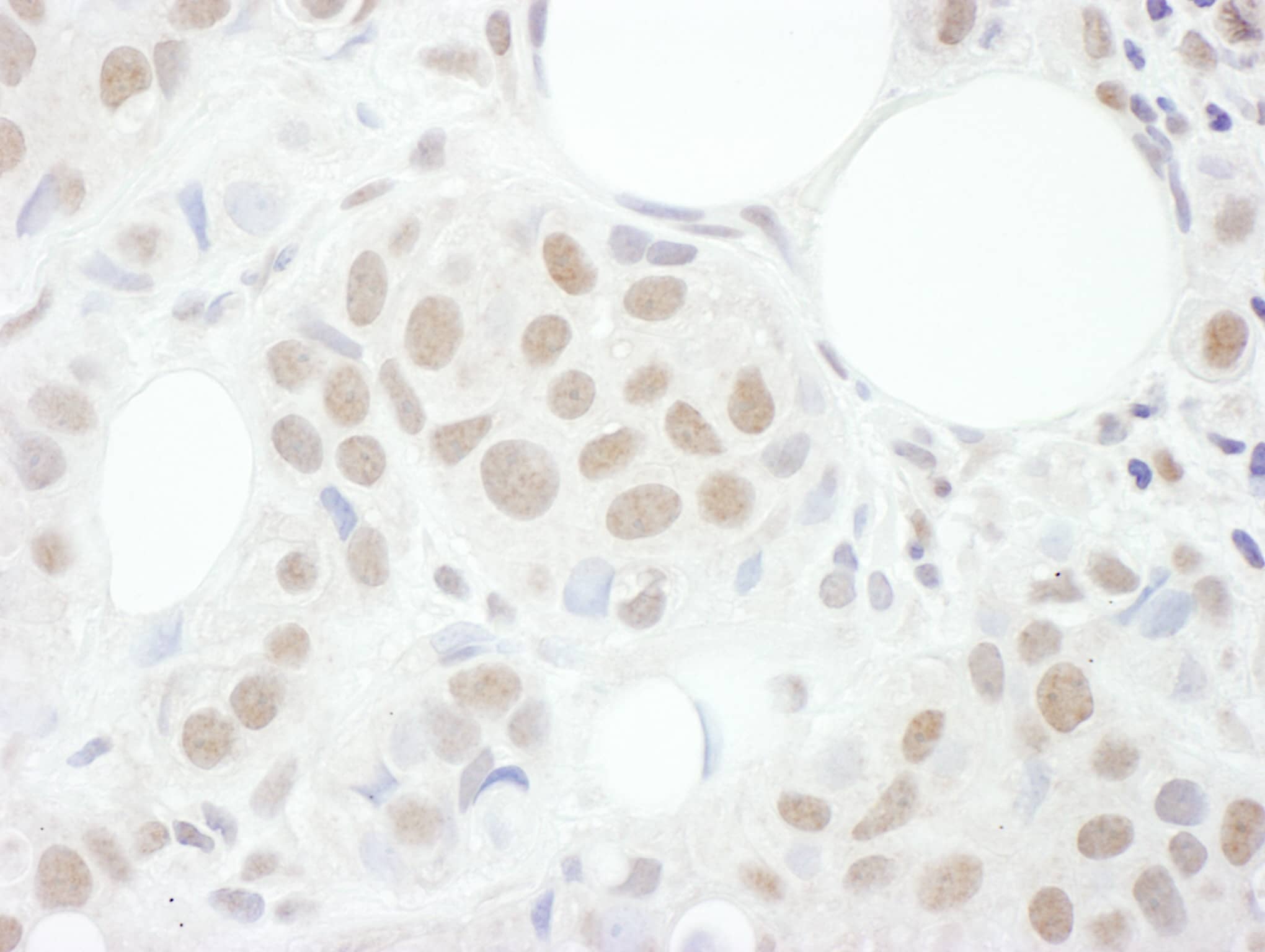 Immunohistochemistry:[NBP3-28931]-Detection of human Cyclin T1 by immunohistochemistry. Sample: FFPE section of human breast carcinoma. Antibody: Affinity purified rabbit anti-Cyclin T1 used at a dilution of 1: 200. Detection: DAB