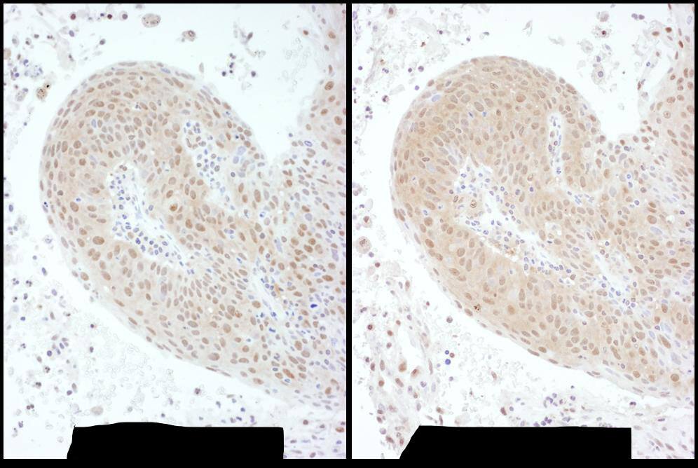 Immunohistochemistry:[NBP3-28965]-Detection of human PSMC6 by immunohistochemistry. Samples: FFPE serial sections of human lung carcinoma. Antibody: Affinity purified rabbit anti-PSMC6 used at a dilution of 1: 1,000. Detection: DAB. Counterstain: hematoxylin.