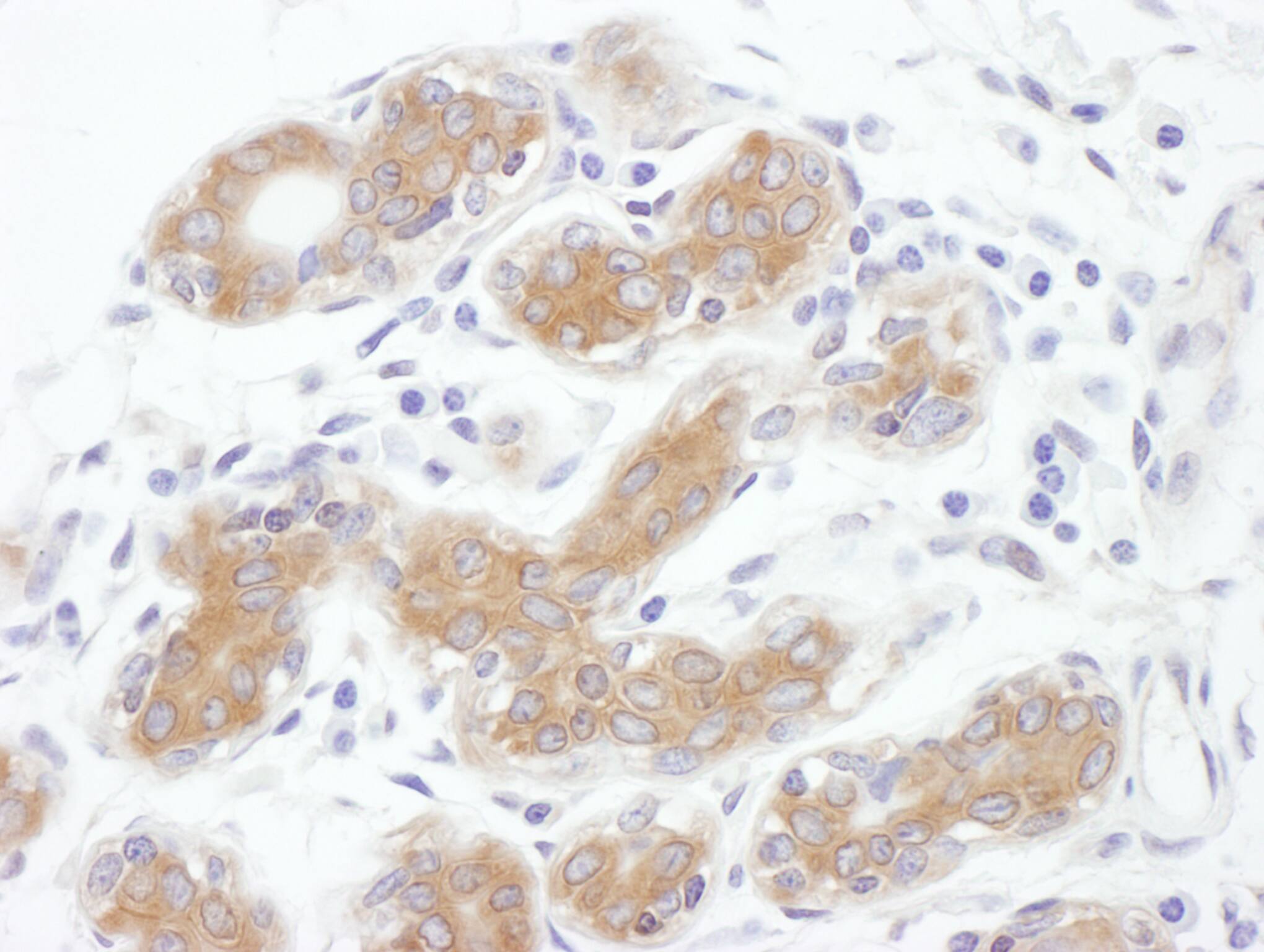 Immunohistochemistry:[NBP3-28996]-Detection of human ALIX by immunohistochemistry. Sample: FFPE section of human breast carcinoma. Antibody: Affinity purified rabbit anti-ALIX used at a dilution of 1: 200. Detection: DAB