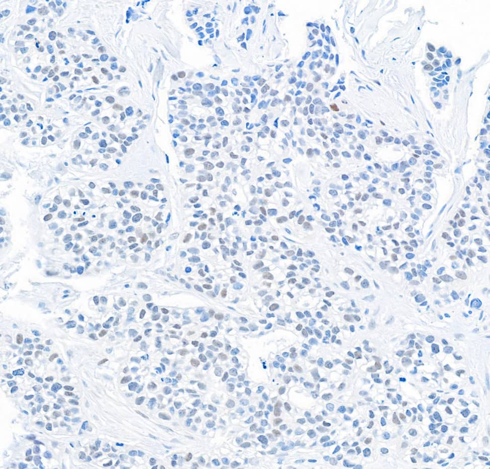 Immunohistochemistry;DEC1 Antibody[NBP3-28997]Detection of human DEC1 by immunohistochemistry. Sample: FFPE section of human breast carcinoma. Antibody: Affinity purified rabbit anti-DEC1  used at a dilution of 1:1,000 . Detection: DAB