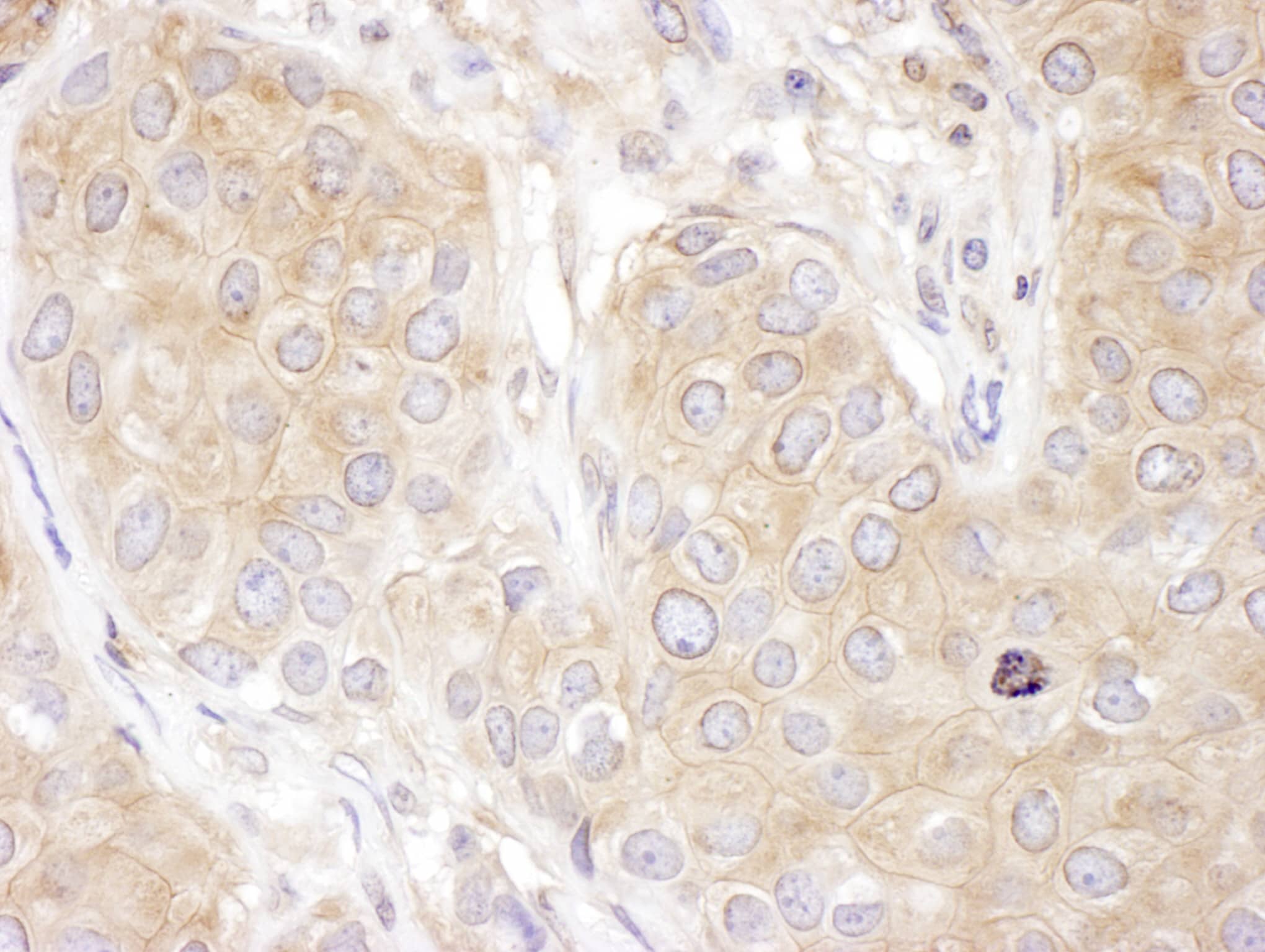 Immunohistochemistry:[NBP3-29034]-Detection of human DCTN2 by immunohistochemistry. Sample: FFPE section of human breast carcinoma. Antibody: Affinity purified rabbit anti-DCTN2 used at a dilution of 1: 200. Detection: DAB. Counterstain: Hematoxylin.