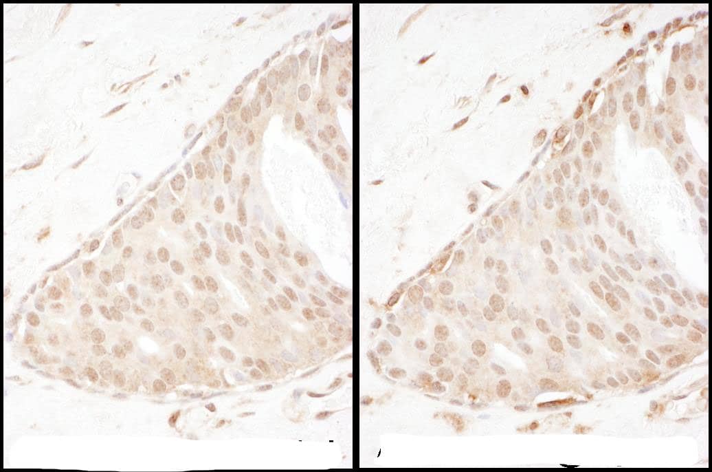 Immunohistochemistry:[NBP3-29035]-Detection of human Beta-Arrestin 2 by immunohistochemistry. Samples: FFPE sections of human breast carcinoma. Antibody: Affinity purified rabbit -Arrestin 2 1 used at a dilution of 1: 1,000 used at a dilution of 1: 1,000. Detection: DAB