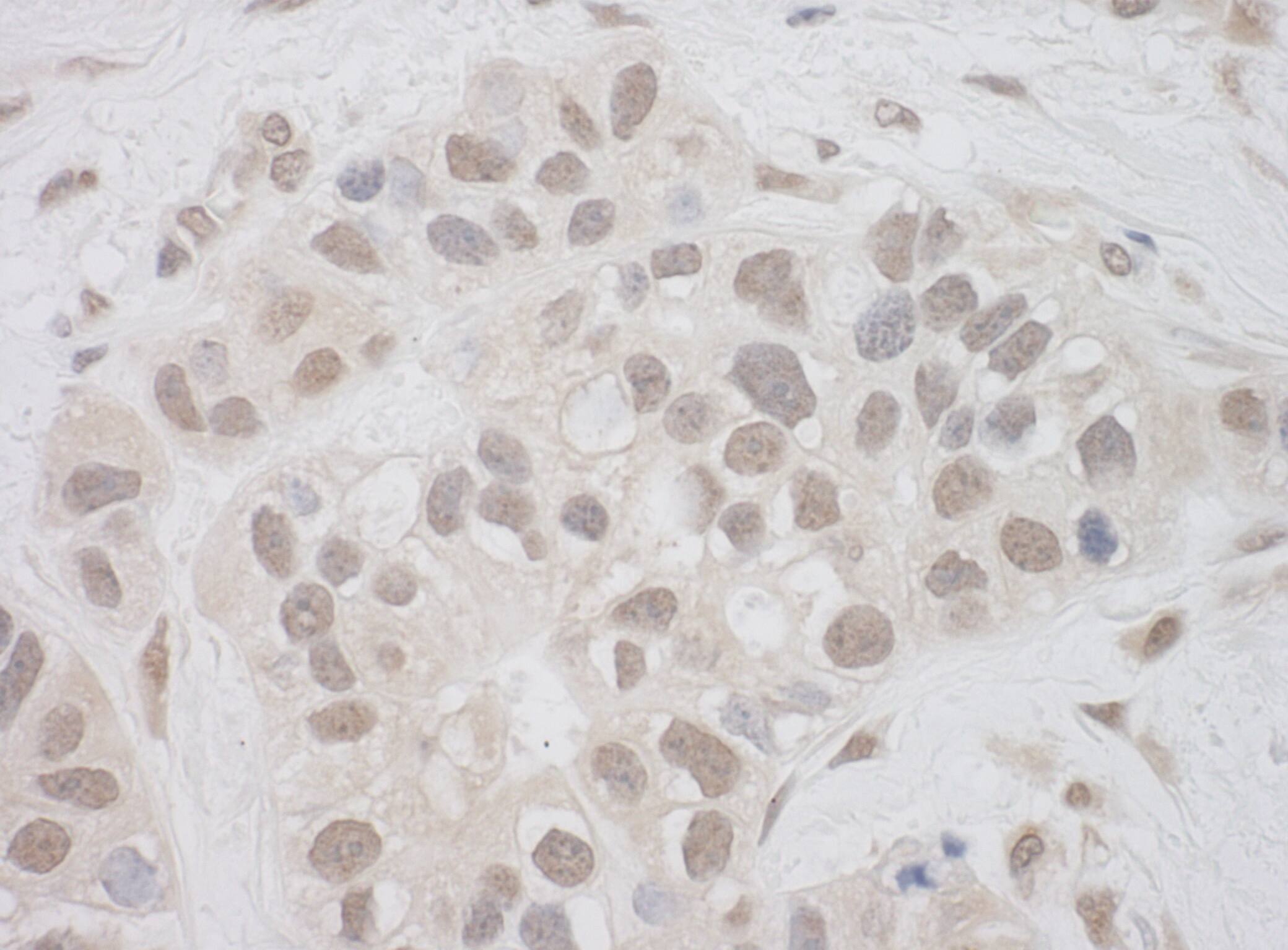 Immunohistochemistry:[NBP3-29036]-Detection of human SUPT7L by immunohistochemistry. Sample: FFPE section of human breast carcinoma. Antibody: Affinity purified rabbit anti-SUPT7L used at a dilution of 1: 200 Detection: DAB