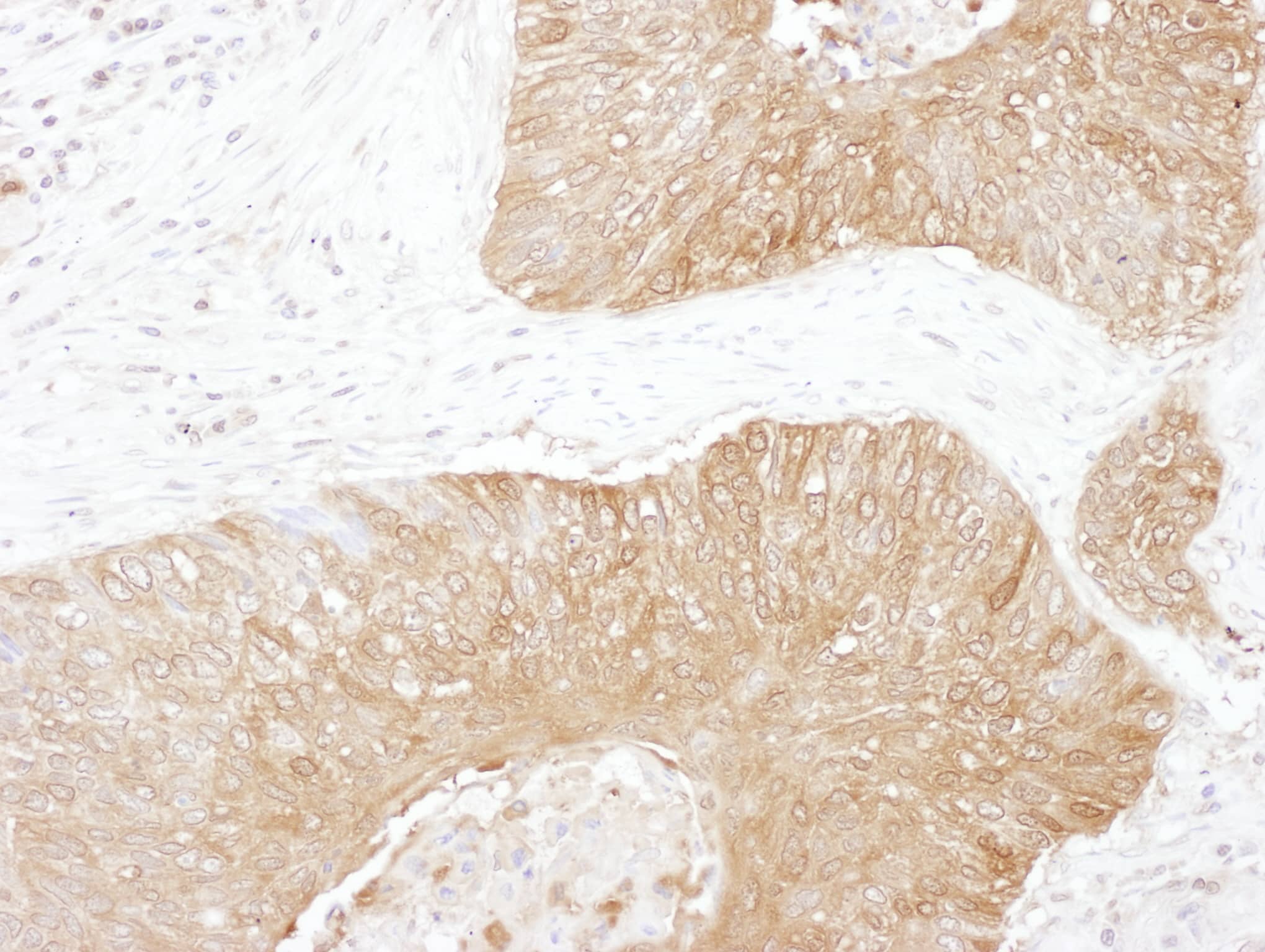 Immunohistochemistry;Glucose 6 phosphate isomerase Antibody[NBP3-29035]Detection of human GPI by immunohistochemistry. Sample: FFPE section of human lung carcinoma. Antibody: Affinity purified rabbit anti-GPI  used at a dilution of 1:1,000 . Detection: DAB. Counterstain: hematoxylin .