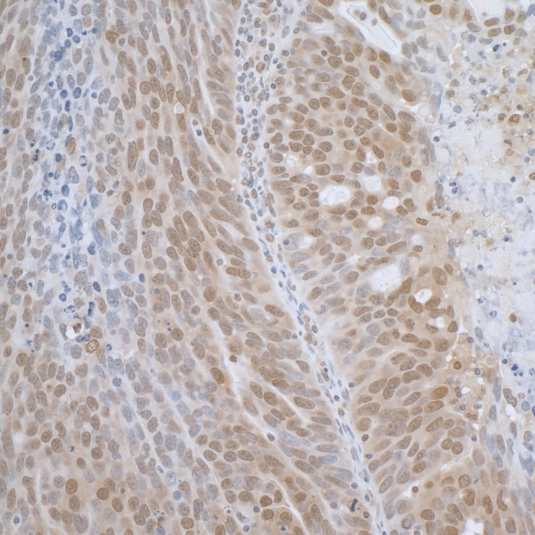 Immunohistochemistry;TCEB1 Antibody[NBP3-29056]Detection of human TCEB1 by immunohistochemistry. Sample: FFPE section of human ovarian carcinoma. Antibody: Affinity purified rabbit anti-TCEB1  used at a dilution of 1:1,000 . Detection: DAB. Counterstain: IHC Hematoxylin .