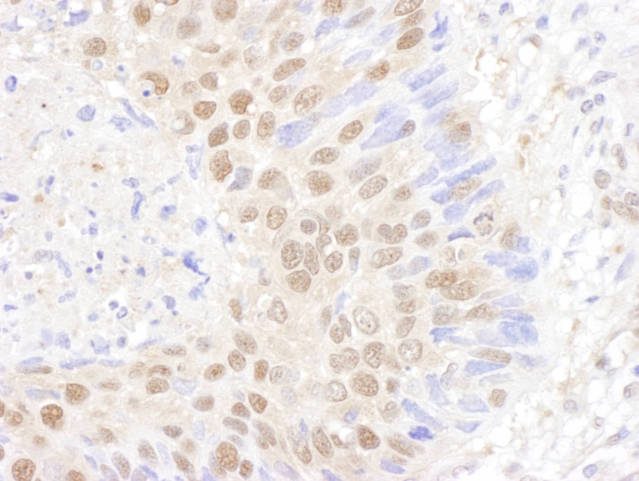 Immunohistochemistry;PSMB7 Antibody[NBP3-29057]Detection of human PSMB7 by immunohistochemistry. Sample: FFPE section of human non-small cell lung cancer. Antibody: Affinity purified rabbit anti-PSMB7  used at a dilution of 1:5,000 . Detection: DAB. Counterstain: hematoxylin .