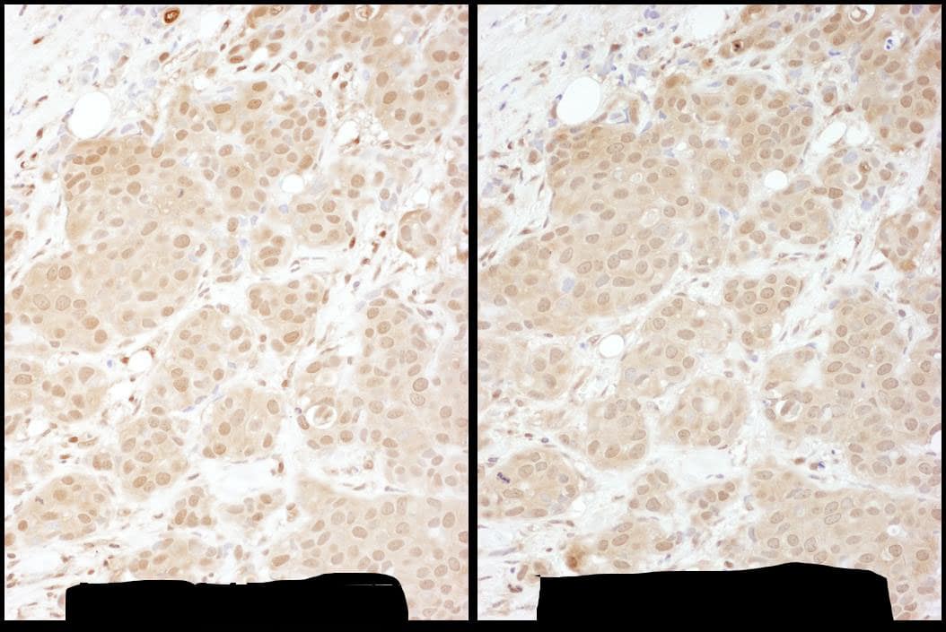 Immunohistochemistry:[NBP3-29059]-Detection of human PSMA1 by immunohistochemistry. Samples: FFPE serial sections of human breast carcinoma. Antibody: Affinity purified rabbit anti-PSMA1 used at a dilution of 1: 1,000. Detection: DAB. Counterstain: hematoxylin.