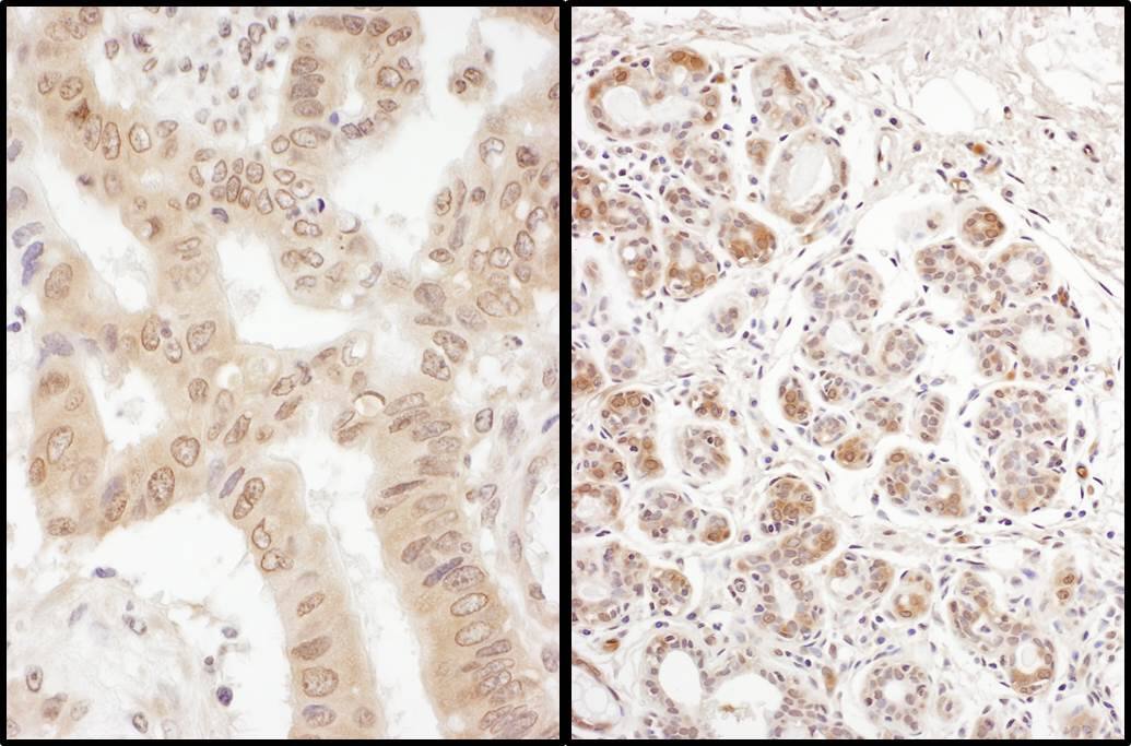 Immunohistochemistry:[NBP3-29067]-Detection of human eIF2B delta/EIF2B4 by immunohistochemistry. Samples: FFPE sections of human colon carcinoma and breast carcinoma. Antibody: Affinity purified rabbit anti-eIF2B delta/EIF2B4 used at a dilution of 1: 200. Detection: DAB