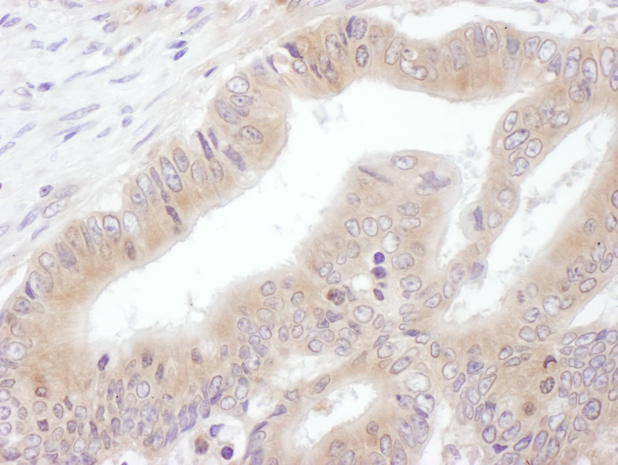 Immunohistochemistry:[NBP3-29068]-Detection of human eIF3E by immunohistochemistry. Sample: FFPE section of human ovarian carcinoma. Antibody: Affinity purified rabbit anti-eIF3E used at a dilution of 1: 200. Detection: DAB