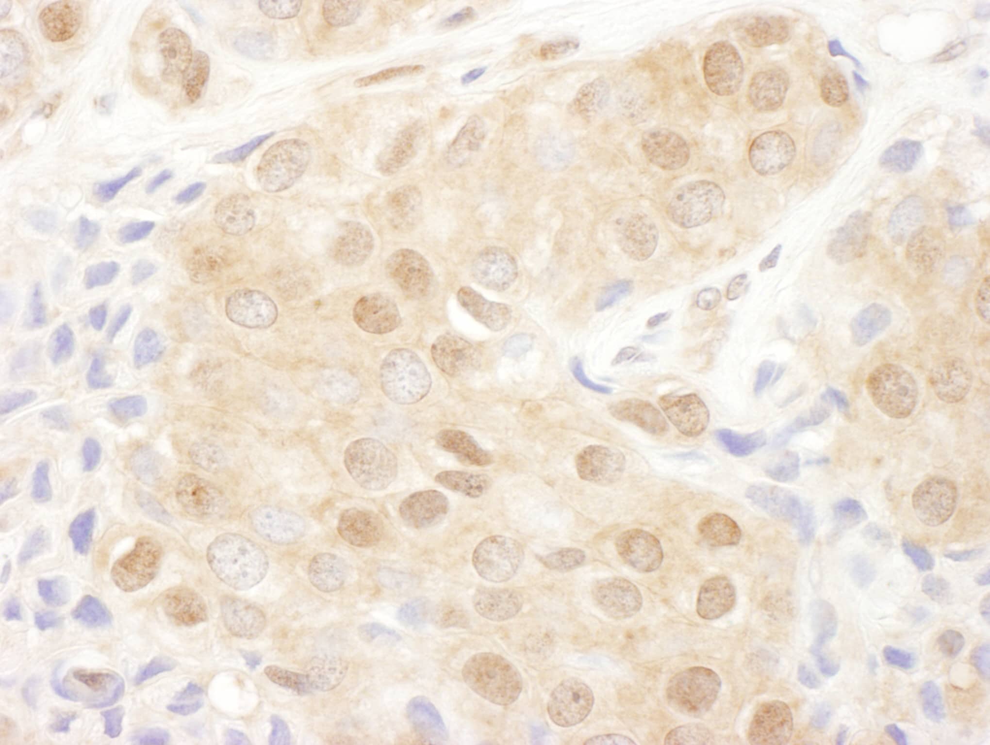 Immunohistochemistry;Proteasome 19S 10B Antibody[NBP3-29059]Detection of human PCMD2 by immunohistochemistry. Sample: FFPE section of human ovarian carcinoma. Antibody: Affinity purified rabbit anti-PSMD2  used at a dilution of 1:1,000 . Detection: DAB