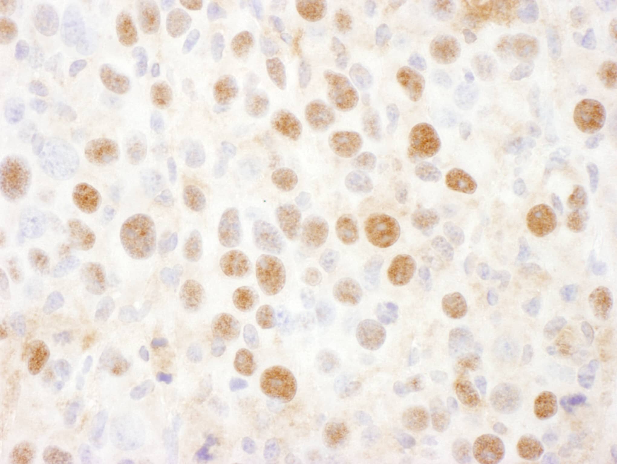 Immunohistochemistry;Proteasome 19S 10B Antibody[NBP3-29069]Detection of mouse PCMD2 by immunohistochemistry. Sample: FFPE section of mouse renal cell carcinoma. Antibody: Affinity purified rabbit anti-PSMD2  used at a dilution of 1:1,000 . Detection: DAB