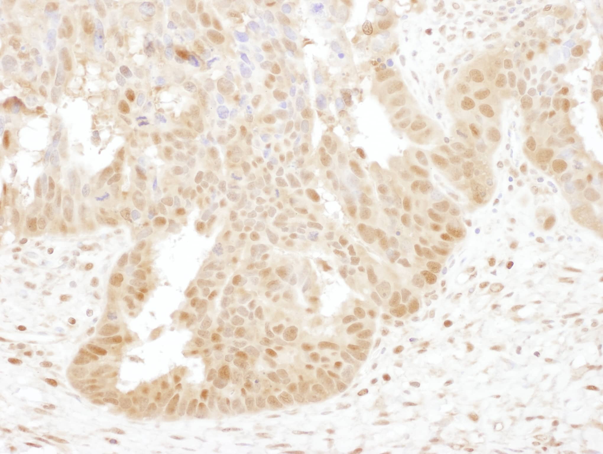 Immunohistochemistry;Proteasome subunit beta type 4 Antibody[NBP3-29087]Detection of human PSMB4 by immunohistochemistry. Sample: FFPE section of human ovarian carcinoma. Antibody: Affinity purified rabbit anti-PSMB4  used at a dilution of 1:1,000 . Detection: DAB. Counterstain: hematoxylin .