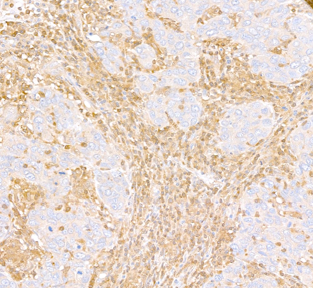 Immunohistochemistry;D4-GDI/RhoGDI2 Antibody[NBP3-29103]Detection of human ARHGDIB/D4-GDI by immunohistochemistry. Sample: FFPE section of human breast carcinoma inflammatory cell infiltrate. Antibody: Affinity purified rabbit anti-ARHGDIB/D4-GDI  used at a dilution of 1:5,000 0.2 µg/ml