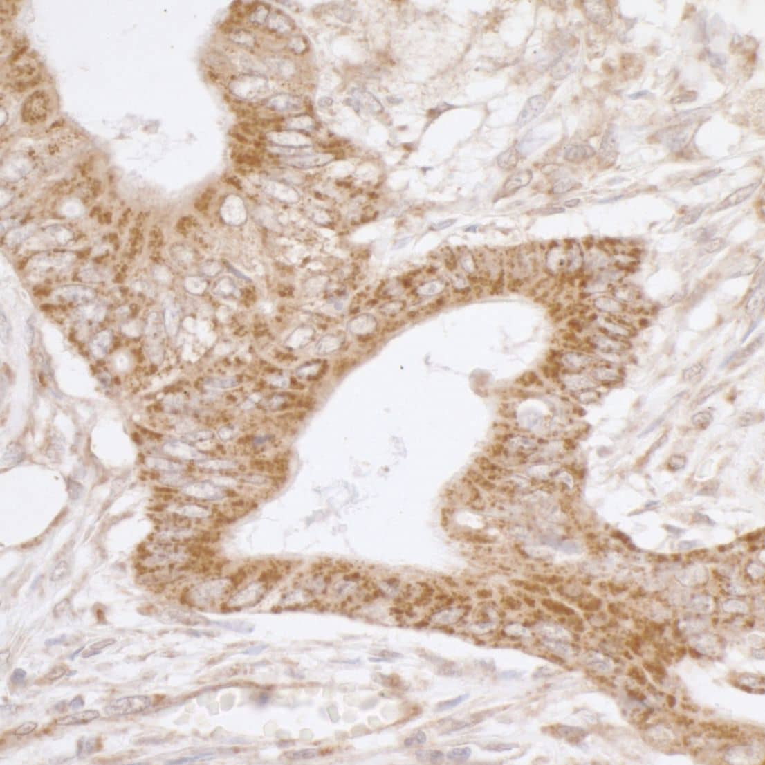 Immunohistochemistry;TRAP1 Antibody[NBP3-29104]Detection of human TRAP1/HSP75 by immunohistochemistry. Sample: FFPE section of human colon carcinoma. Antibody: Affinity purified rabbit anti-TRAP1/HSP75  used at a dilution of 1:1,000 . Detection: DAB