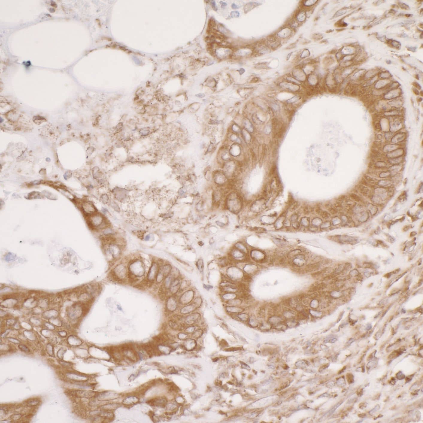 Immunohistochemistry;ERp57/PDIA3 Antibody[NBP3-29115]Detection of human PDIA3 by immunohistochemistry. Sample: FFPE section of human colon carcinoma. Antibody: Affinity purified rabbit anti-PDIA3  used at a dilution of 1:5,000 . Detection: DAB. Counterstain:IHC Hematoxylin .