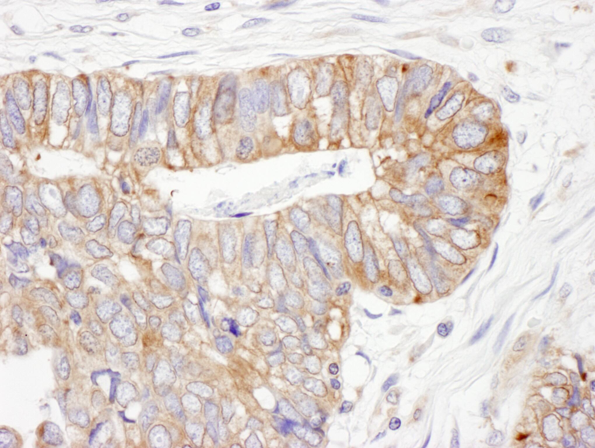 Immunohistochemistry;PDIA6 Antibody[NBP3-29116]Detection of human ERp5 by immunohistochemistry. Sample: FFPE section of human colon carcinoma. Antibody: Affinity purified rabbit anti-ERp5  used at a dilution of 1:5,000 . Detection: DAB. Counterstain: IHC Hematoxylin .