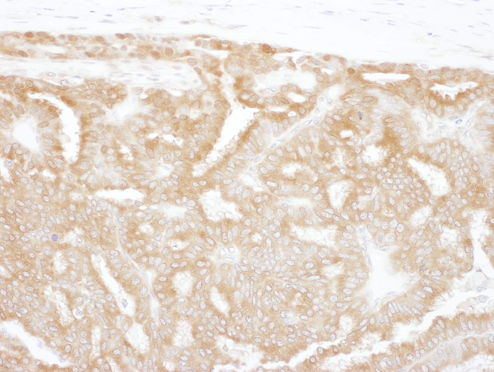 Immunohistochemistry;Glucose 6 phosphate isomerase Antibody[NBP3-29128]Detection of human GPI by immunohistochemistry. Sample: FFPE section of human ovarian carcinoma. Antibody: Affinity purified rabbit anti-GPI  used at a dilution of 1:5,000 . Detection: DAB. Counterstain: hematoxylin .