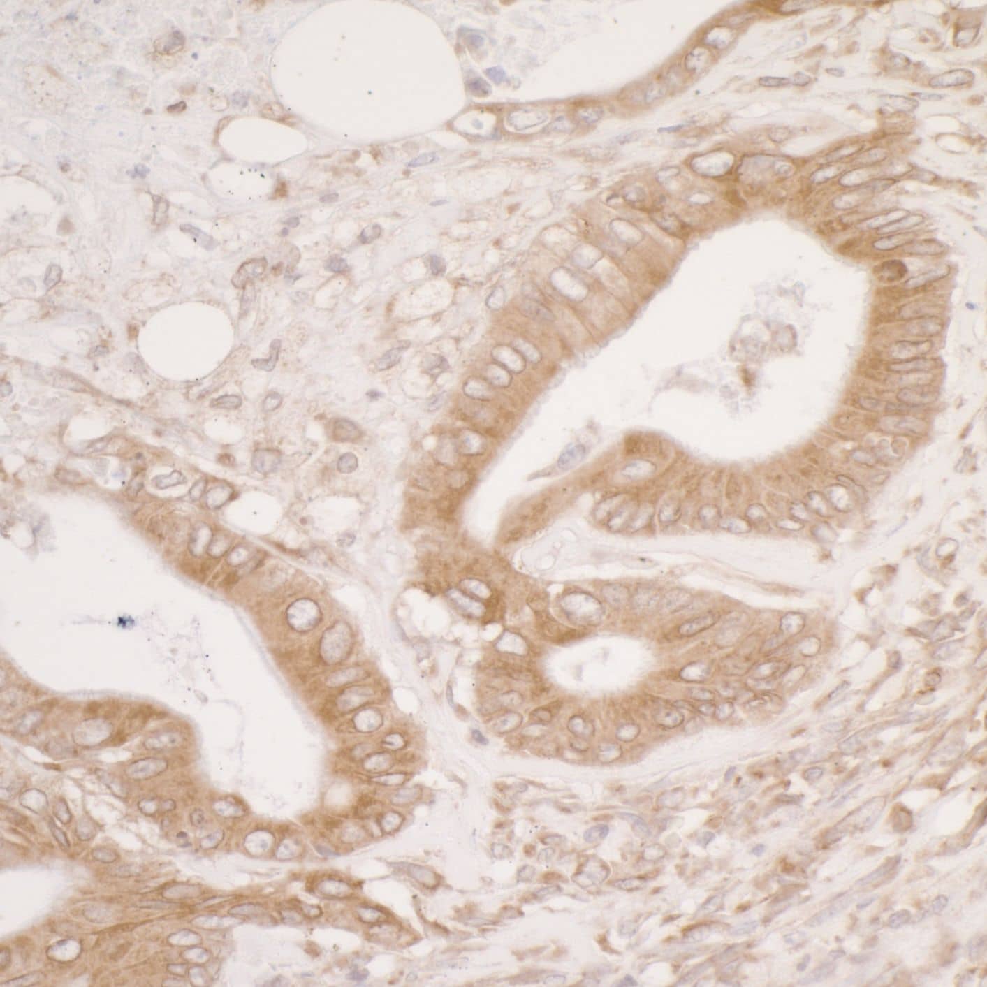 Immunohistochemistry;ERp57/PDIA3 Antibody[NBP3-29141]Detection of human PDIA3 by immunohistochemistry. Sample: FFPE section of human colon carcinoma. Antibody: Affinity purified rabbit anti-PDIA3  used at a dilution of 1:5,000 . Detection: DAB. Counterstain: IHC Hematoxylin .