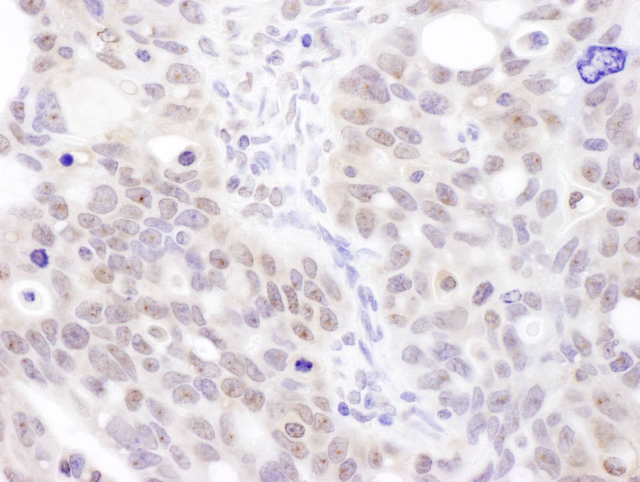 Immunohistochemistry;Coilin Antibody[NBP3-29142]Detection of human Coilin by immunohistochemistry. Sample: FFPE section of human ovarian carcinoma. Antibody: Affinity purified rabbit anti-Coilin  used at a dilution of 1:1,000 . Detection: DAB