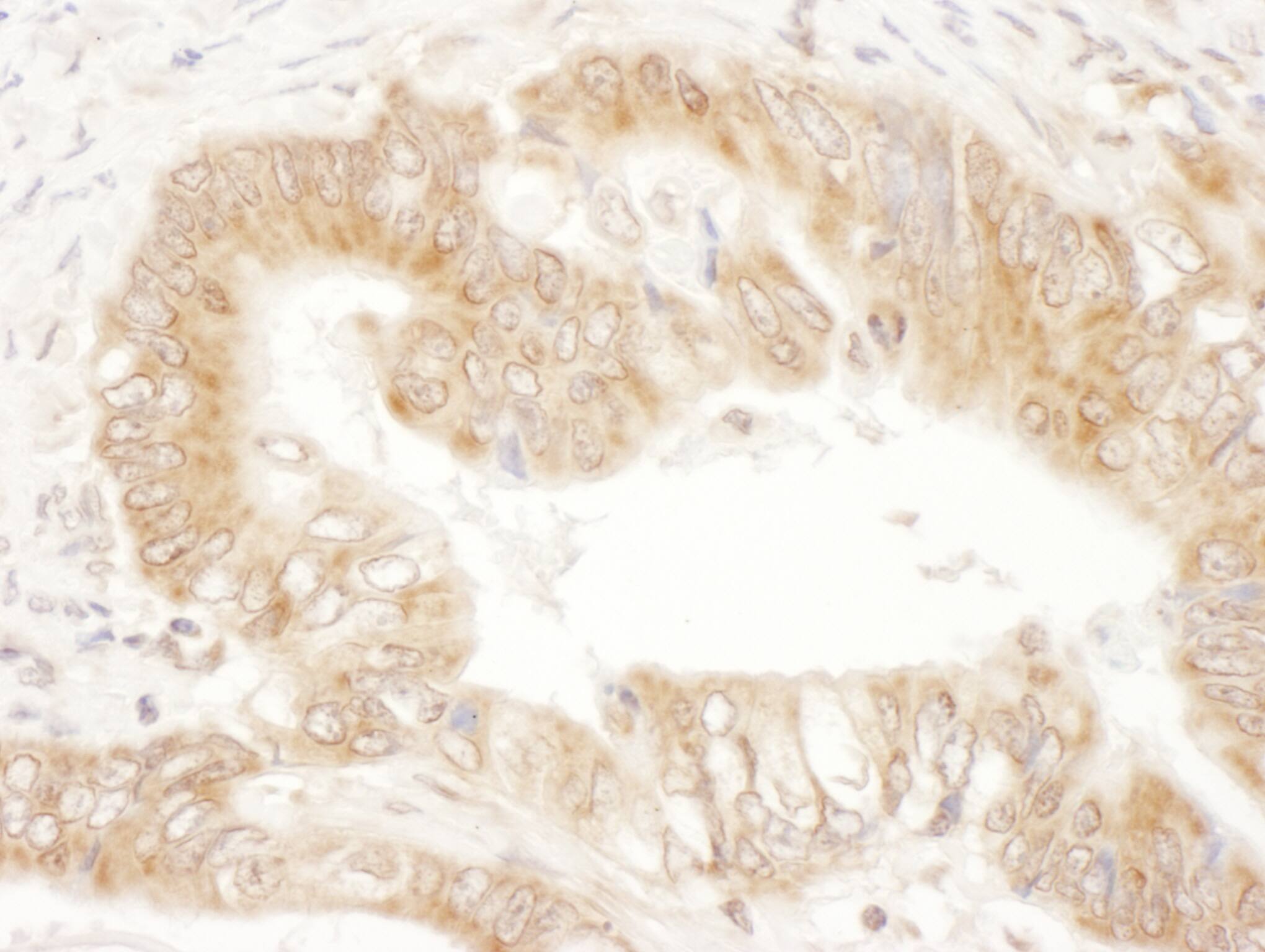 Immunohistochemistry;CaMKK2 Antibody[NBP3-29153]Detection of human CaMKK2 by immunohistochemistry. Sample: FFPE section of human prostate carcinoma. Antibody: Affinity purified rabbit anti-CaMKK2  used at a dilution of 1:1,000 . Detection: DAB