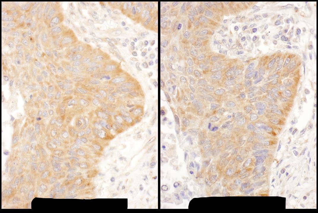 Immunohistochemistry:[NBP3-29155]-Detection of human IGF2BP2 by immunohistochemistry. Samples: FFPE serial sections of human non-small cell lung cancer. Antibody: Affinity purified rabbit anti-IGF2BP2 used at a dilution of 1: 1,000. Detection: DAB