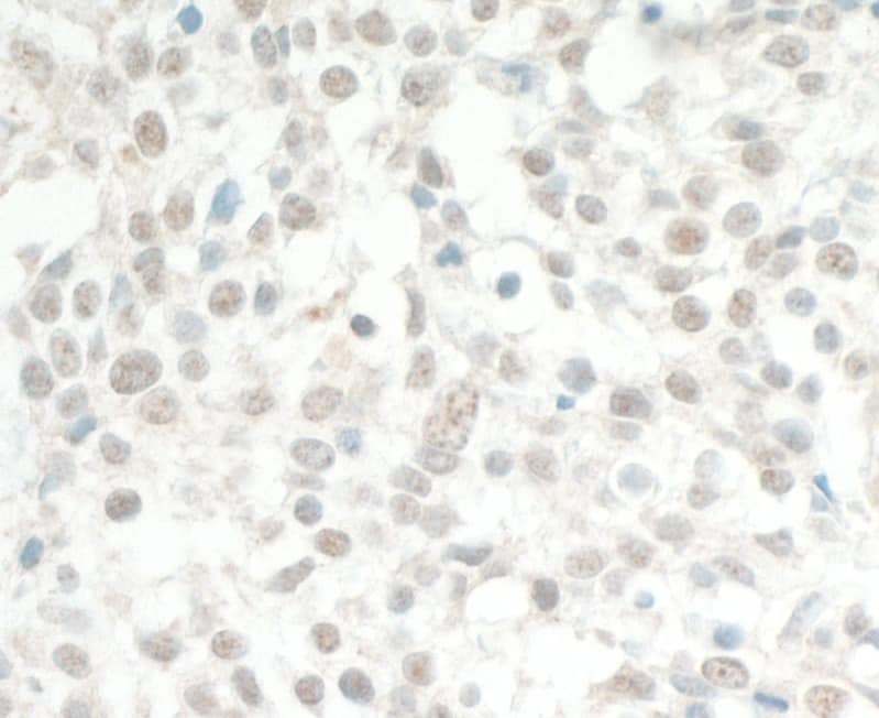 Immunohistochemistry:[NBP3-29178]-Detection of human MED13L by immunohistochemistry. Sample: FFPE section of human lung carcinoma.  Antibody: Affinity purified rabbit anti-MED13L used at 1: 1,000. Detection: DAB