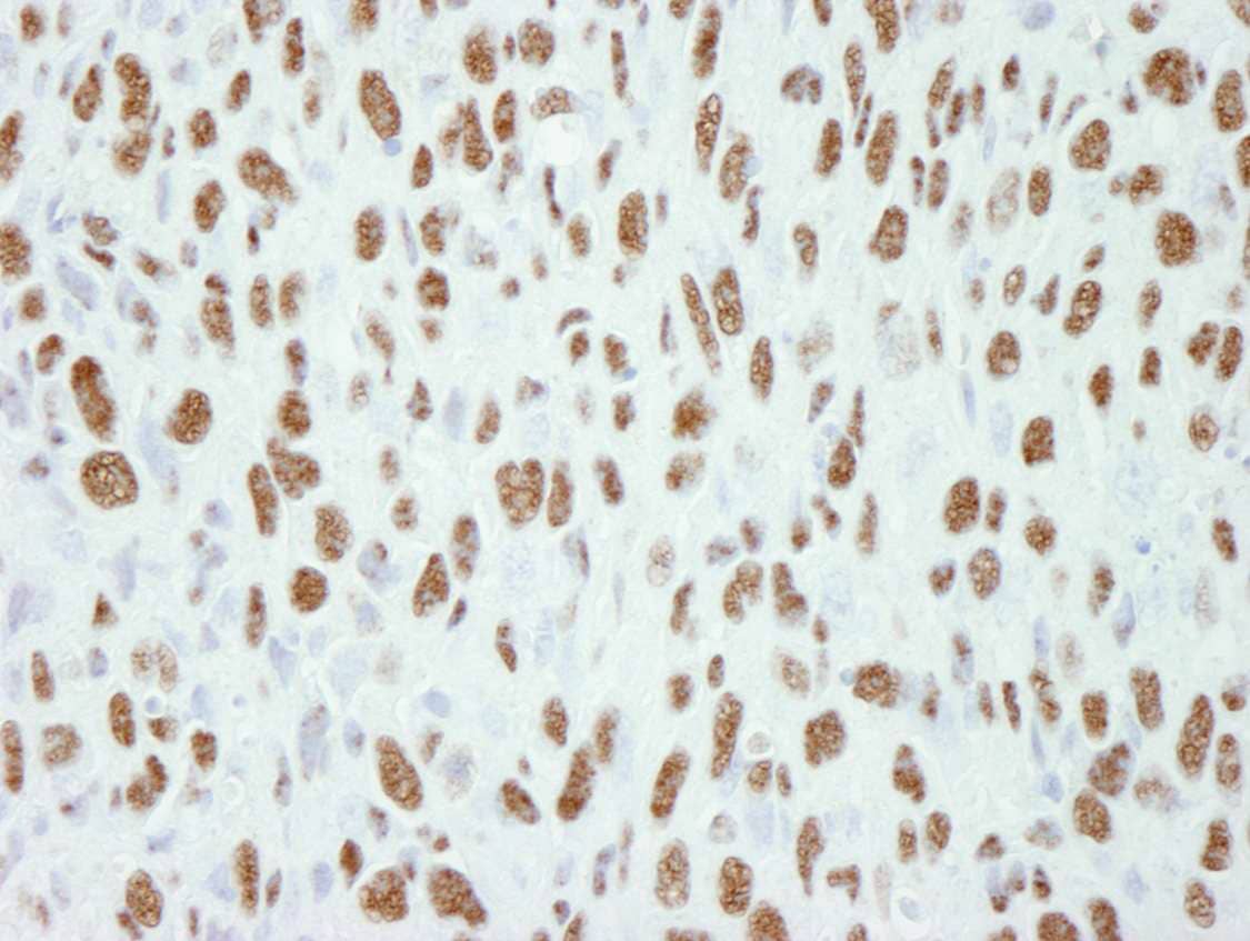 Immunohistochemistry:[NBP3-29203]-Detection of mouse CA150 by immunohistochemistry. Sample: FFPE section of mouse squamous cell carcinoma. Antibody: Affinity purified rabbit anti-CA150.