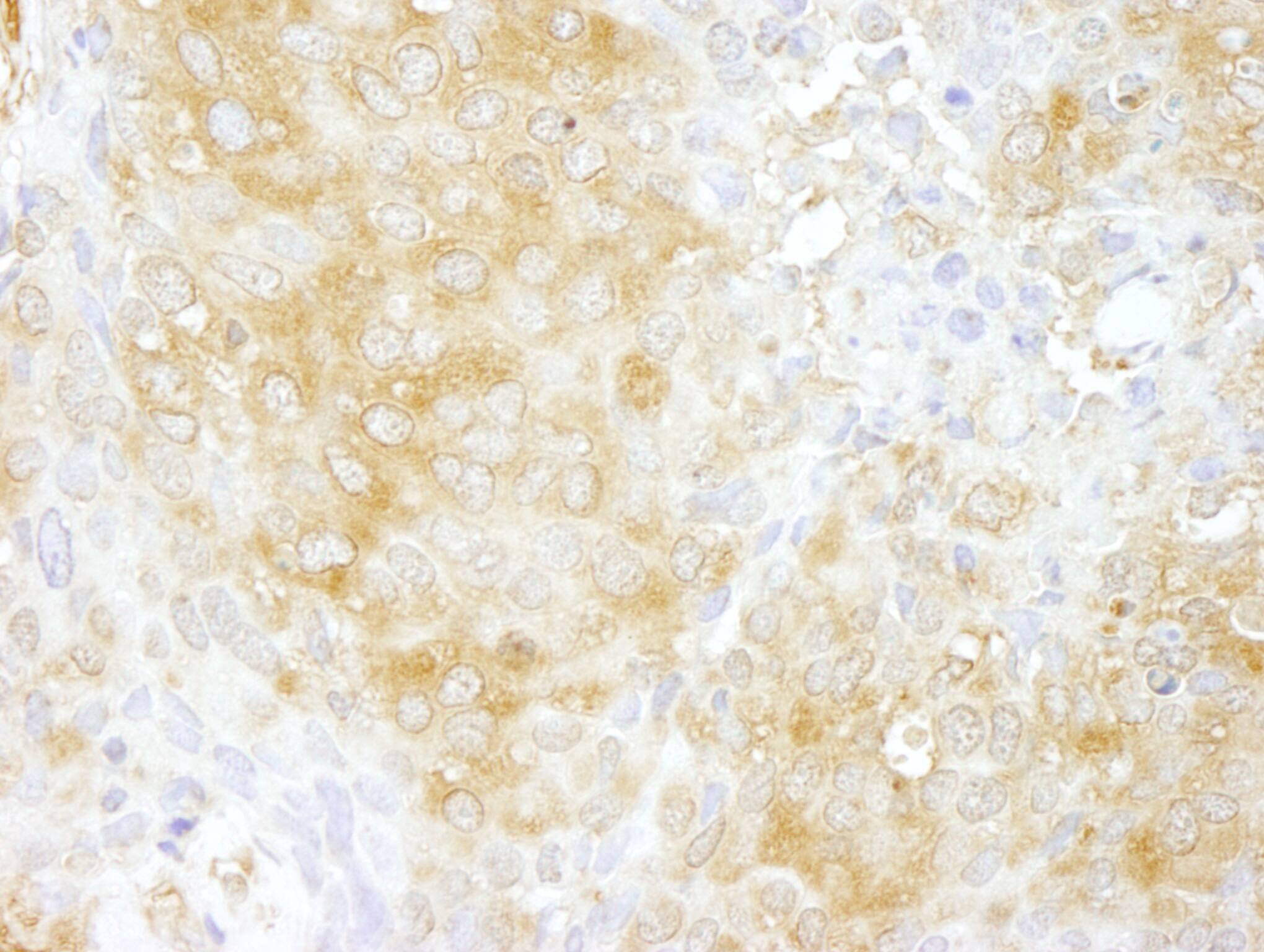 Immunohistochemistry:[NBP3-29209]-Detection of human Cdc42GAP by immunohistochemistry. Sample: FFPE section of human breast carcinoma. Antibody: Affinity purified rabbit anti-Cdc42GAP.