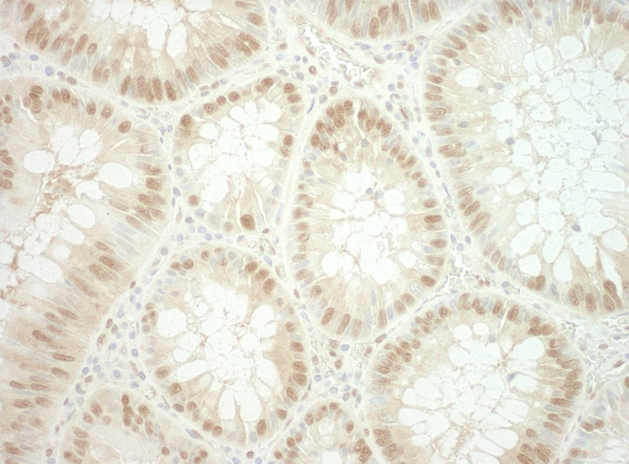 Immunohistochemistry:[NBP3-29215]-Detection of human RuvBL2 by immunohistochemistry. Sample: FFPE section of human colon carcinoma. Antibody: Affinity purified rabbit anti-RuvBL2.