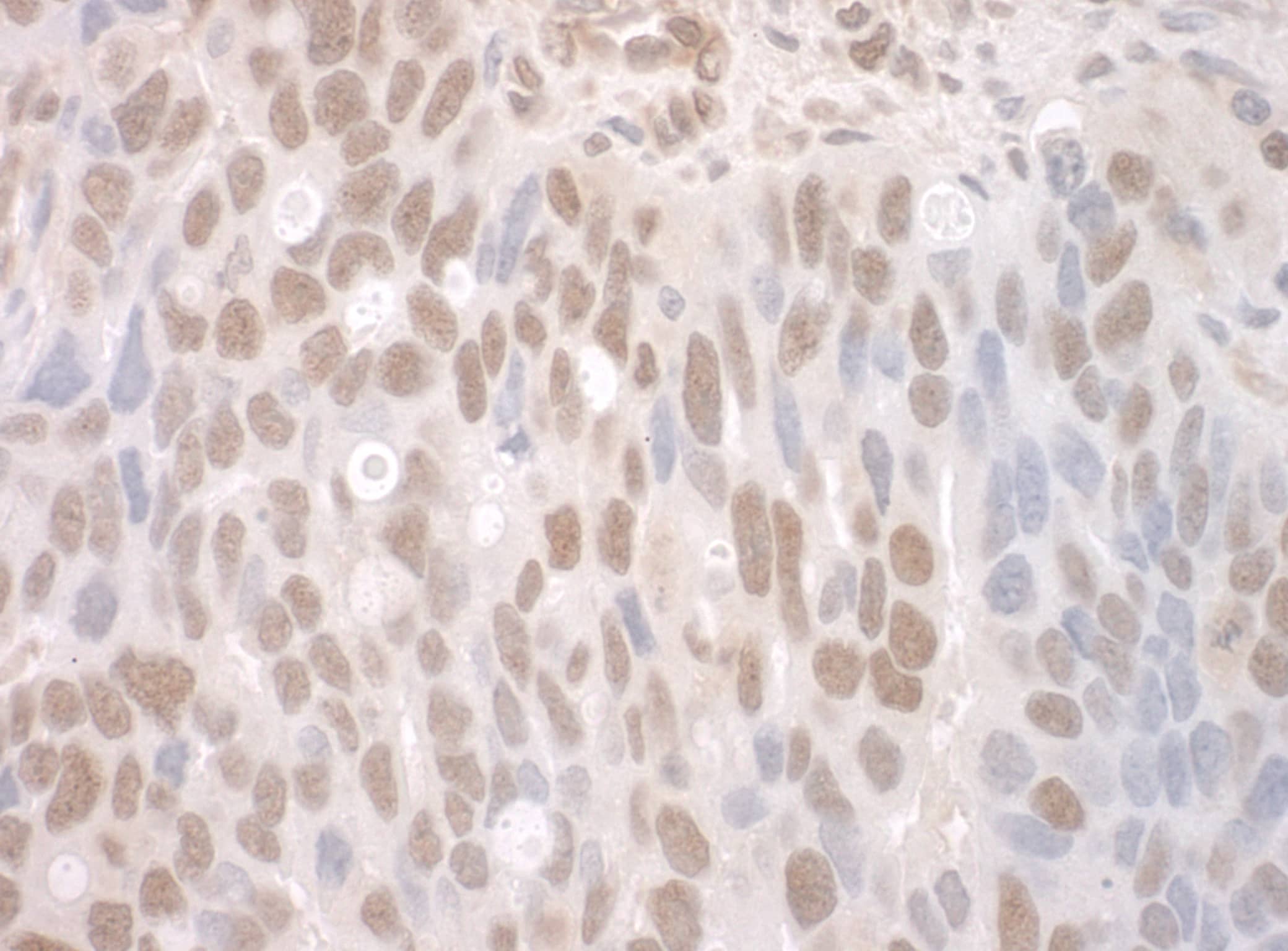 Immunohistochemistry:[NBP3-29217]-Detection of human CTNNBL1 by immunohistochemistry. Sample: FFPE section of human ovarian carcinoma. Antibody: Affinity purified rabbit anti-CTNNBL1.