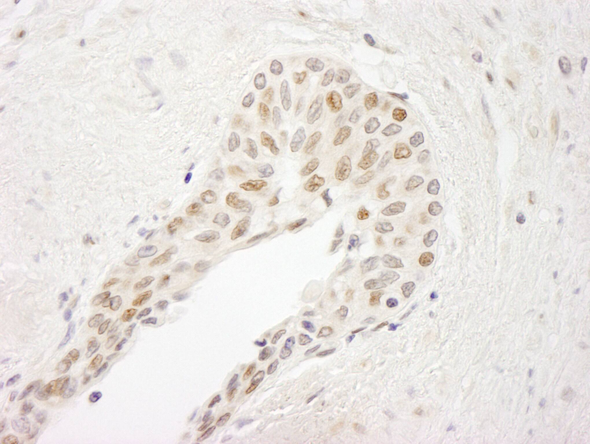 Immunohistochemistry:[NBP3-29219]-Detection of human ATRIP by immunohistochemistry. Sample: FFPE section of human prostate carcinoma. Antibody: Affinity purified rabbit anti-ATRIP.