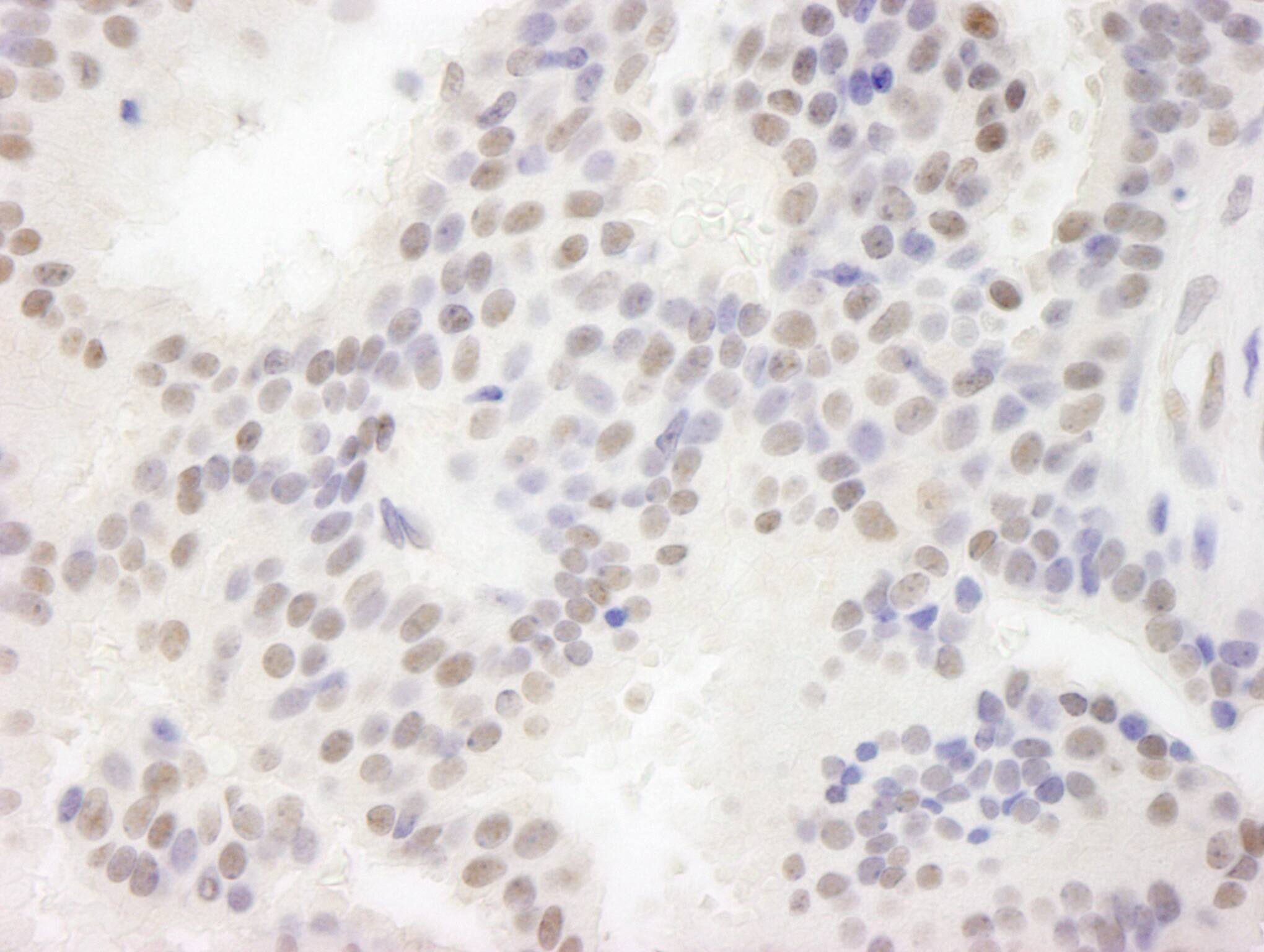 Immunohistochemistry:[NBP3-29224]-Detection of human MAML3 by immunohistochemistry. Sample: FFPE section of human breast carcinoma. Antibody: Affinity purified rabbit anti-MAML3.