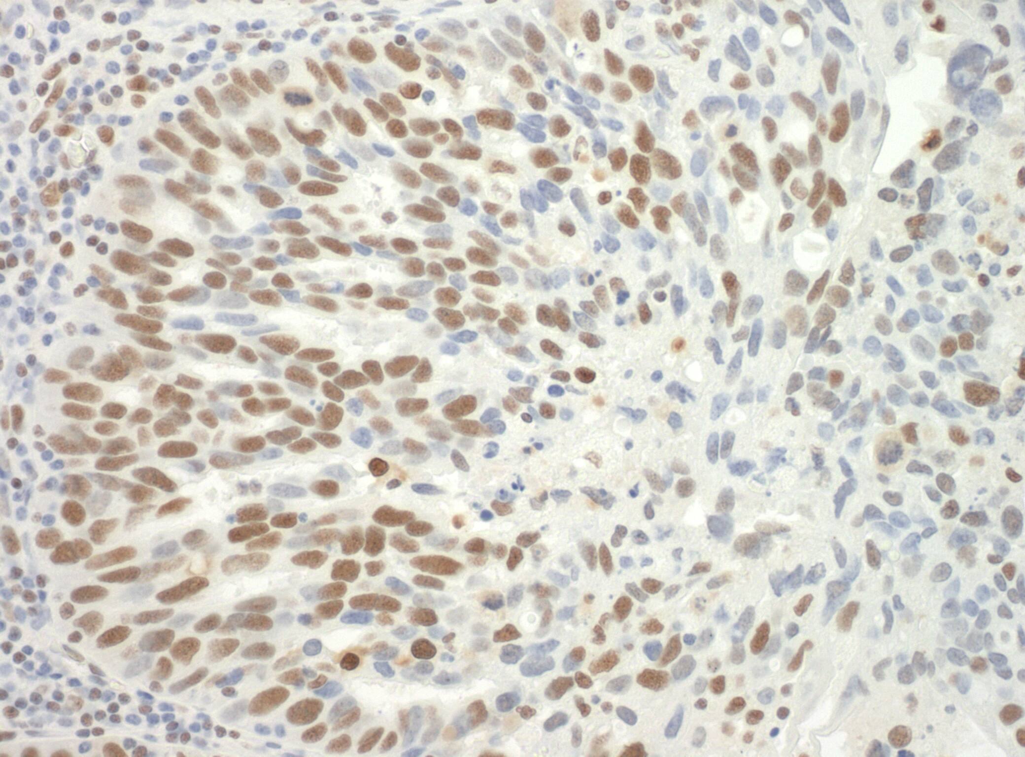 Immunohistochemistry:[NBP3-29225]-Detection of human SF3B3 by immunohistochemistry. Sample: FFPE section of human ovarian carcinoma. Antibody: Affinity purified rabbit anti-SF3B3.